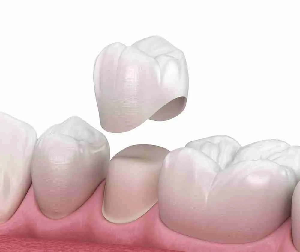 Dental crown, bridge and denture treatment