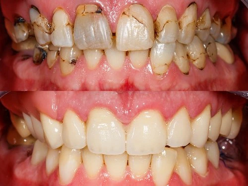 Full Mouth Rehabilitation