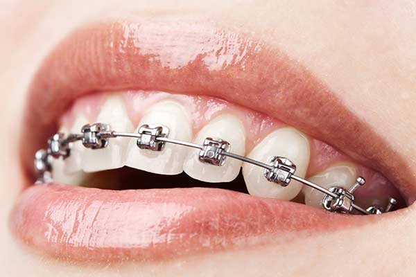 Braces treatment