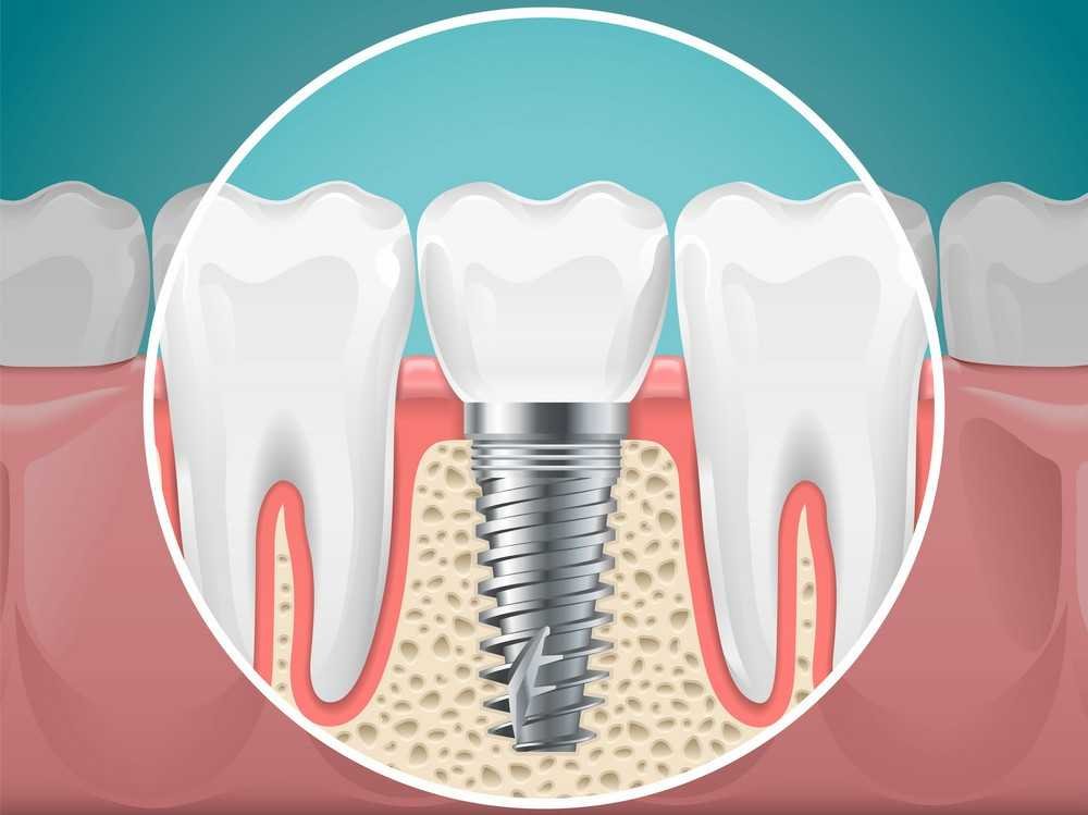 Dental implant treatment