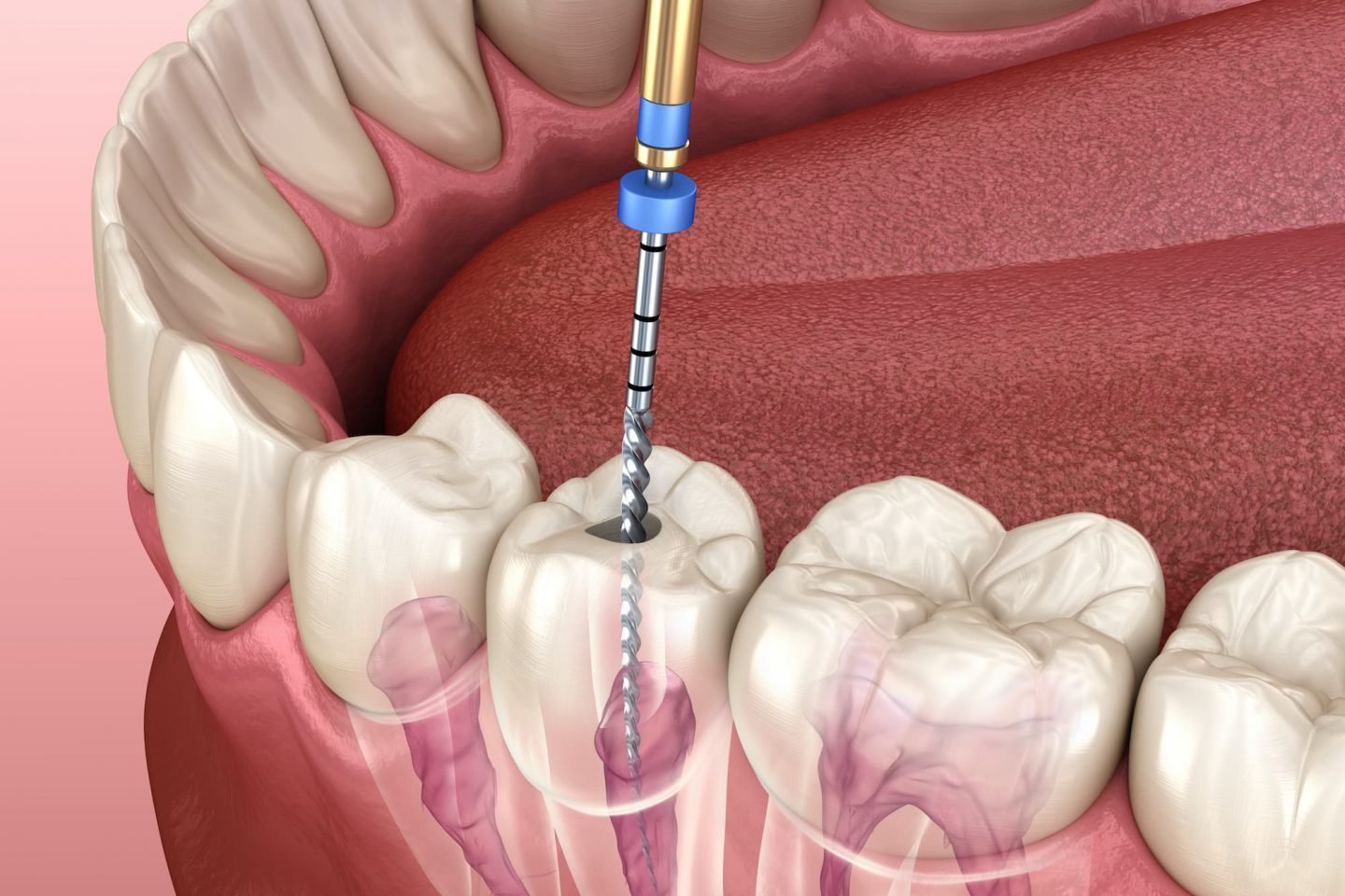 Root canal treatment